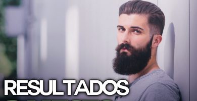 Resultado de 3 meses usando Minoxidil