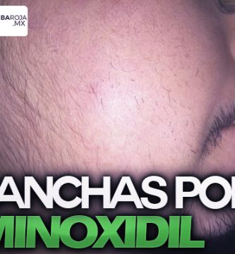 manchas sol minoxidil