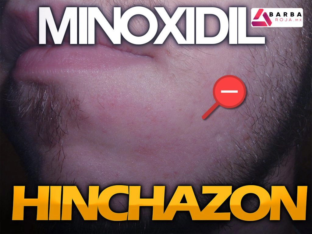 minoxidil inflamacion