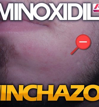 minoxidil inflamacion