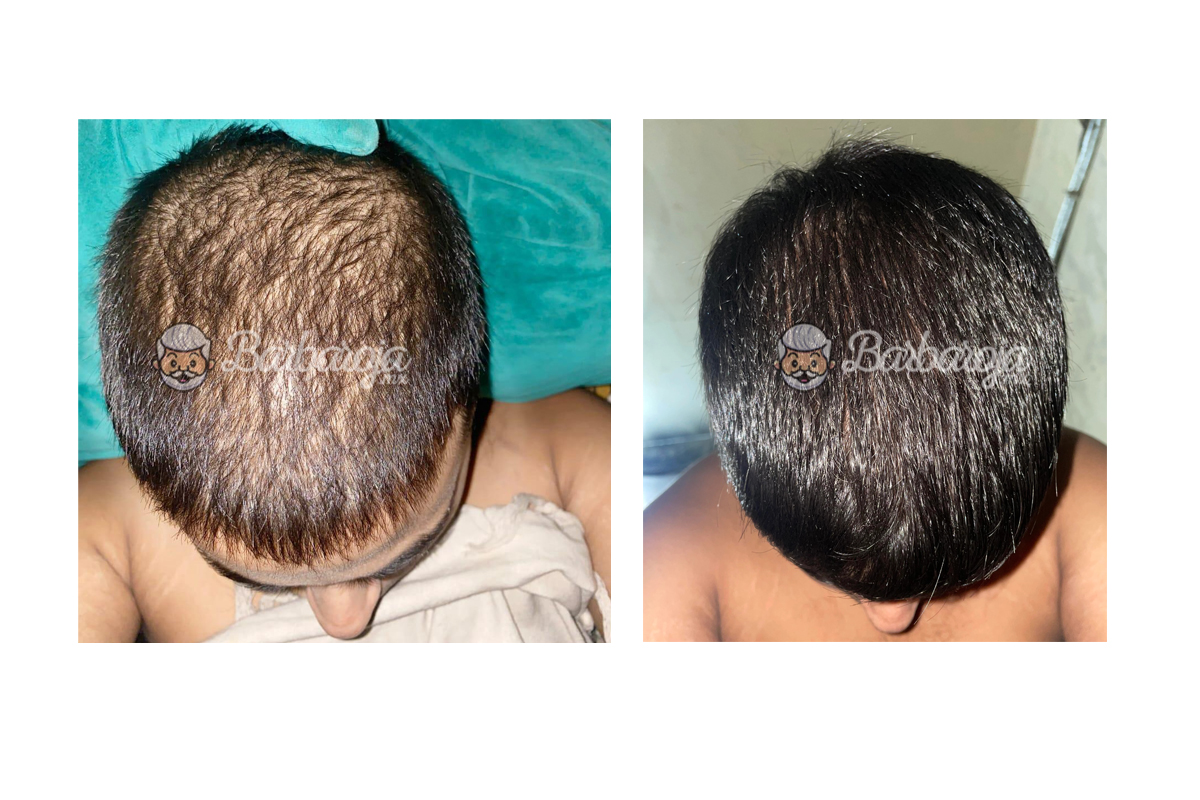 resultados finasteride topico