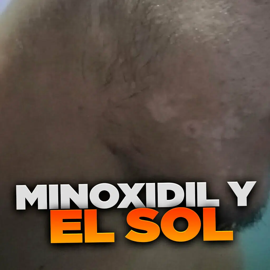 Minoxidil y el sol