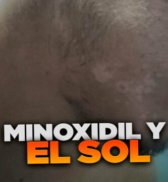 minoxidil y el sol